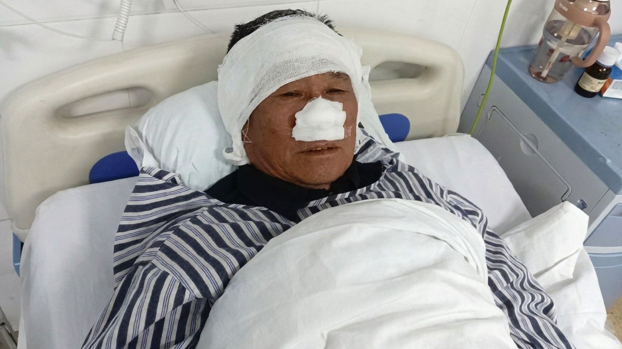 Chinese villager loses nose saving woman from attacker, receives national hero recognition
