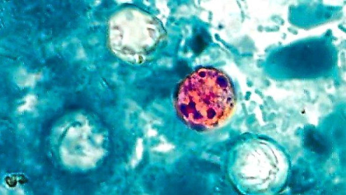 The Detection Dilemma: Why Cyclospora Outbreaks Are So Hard to Track and Control