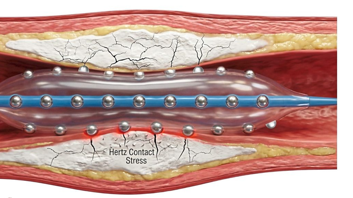 Malaysian Cardiologists Test Advanced Calcium-Busting Heart Treatment
