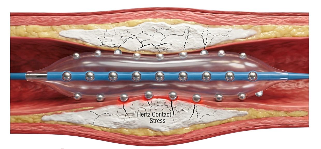 Malaysian Cardiologists Test Advanced Calcium-Busting Heart Treatment